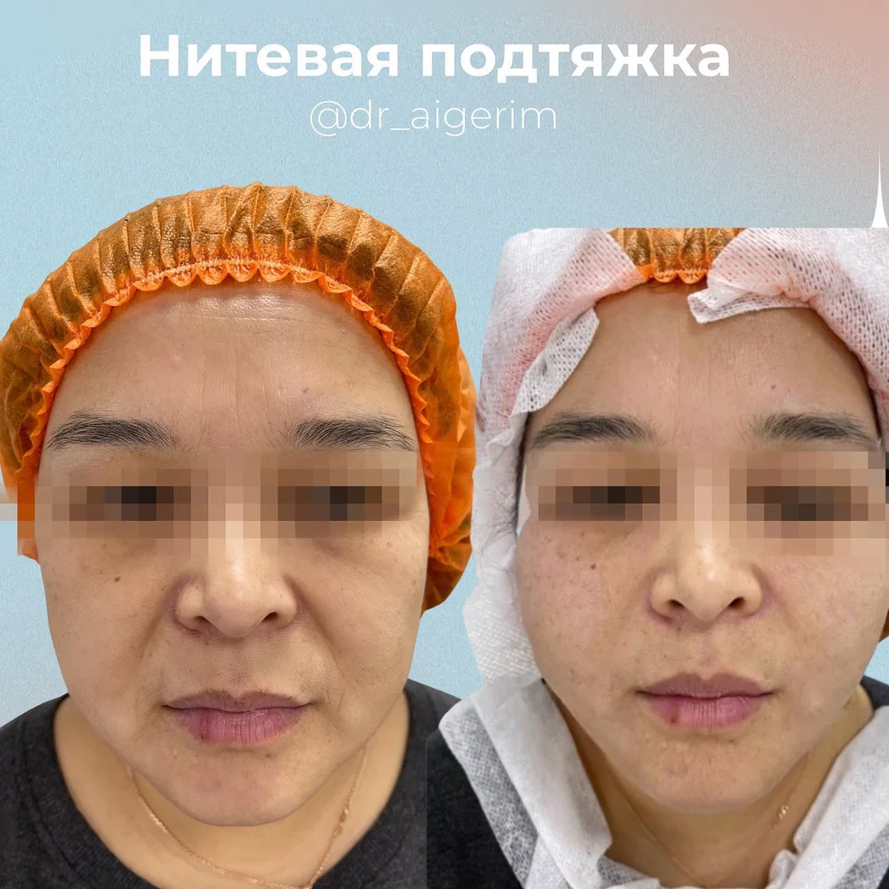 Нитевой лифтинг лица — до процедуры
