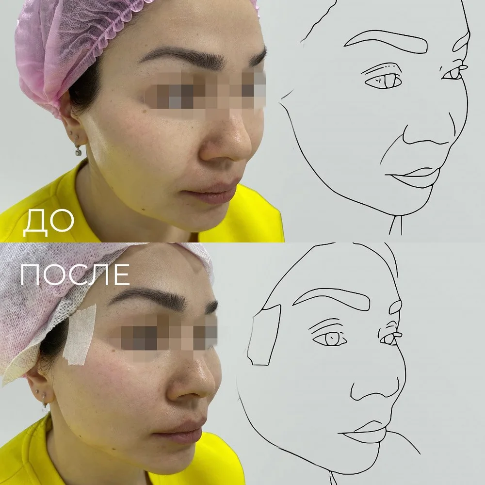 Нитевой лифтинг лица — после процедуры