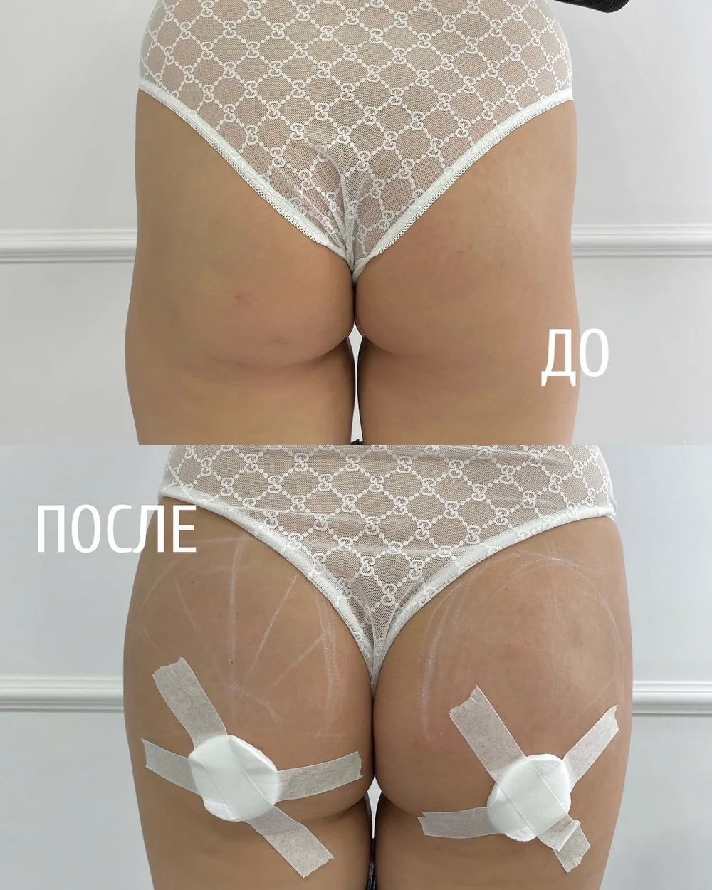 Контурная пластика тела филлером — результат